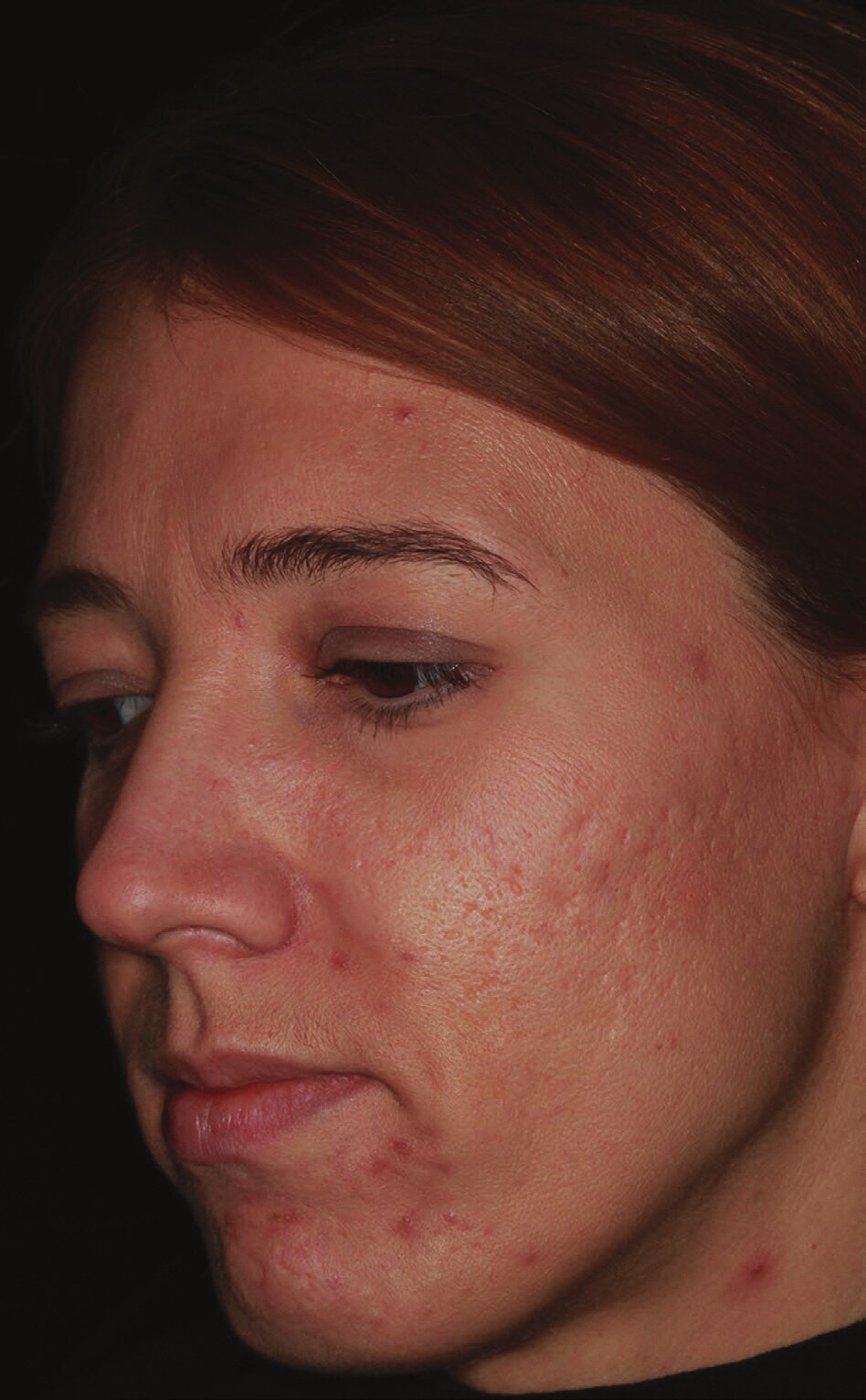 Lumenis AcuPulse acne scar case before fractional CO2 treatment