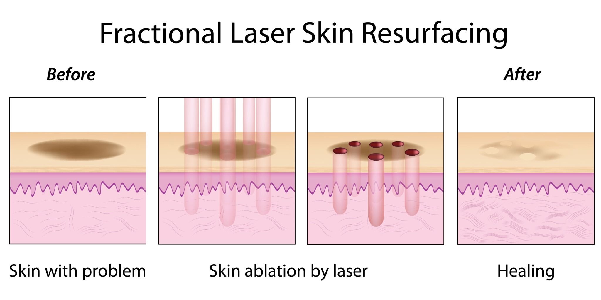 Illustration showing fractional laser columns with untreated skin between them