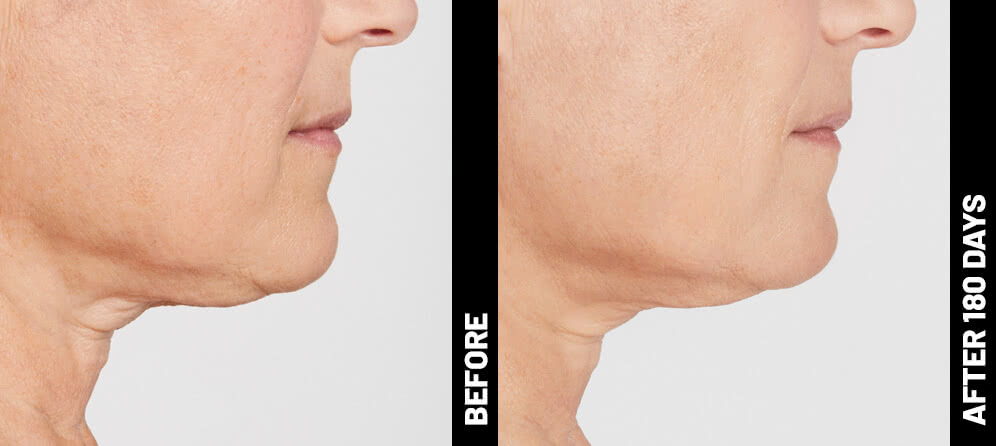 Ultherapy patient under-chin profile before treatment and 180 days after treatment
