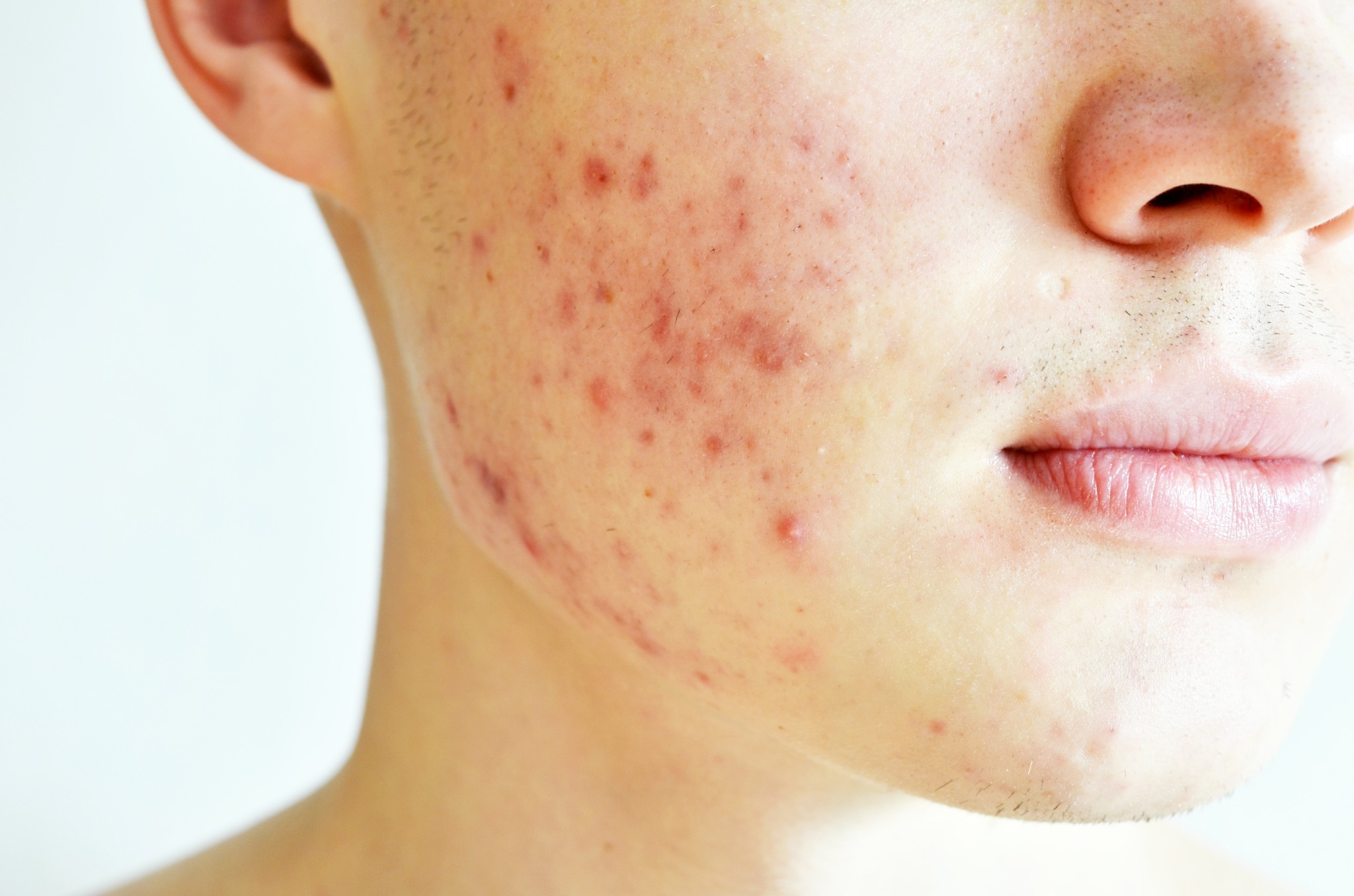 Active facial acne and congestion