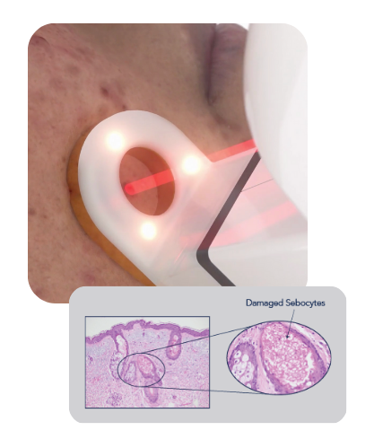 AviClear laser targeting damaged sebaceous glands beneath the skin