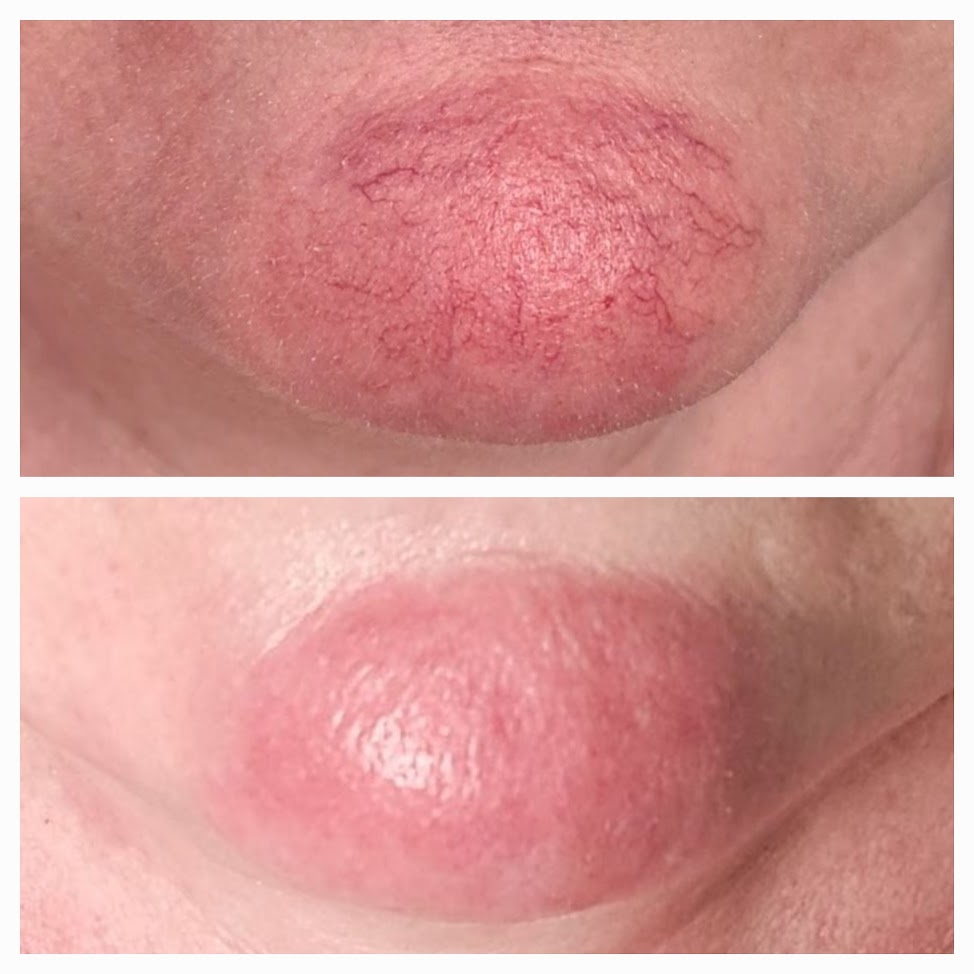Facial capillaries before and after treatment, with the before view above and after view below