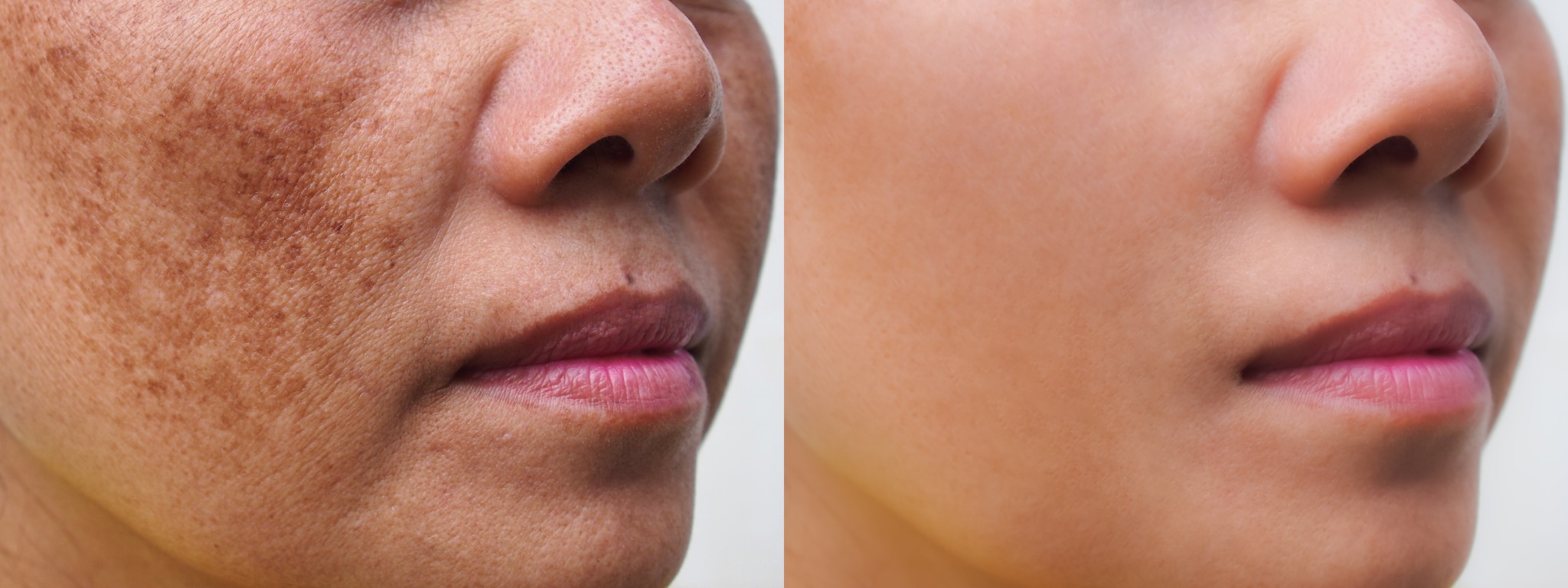 Illustrative side-by-side comparison of facial pigmentation and more even skin tone