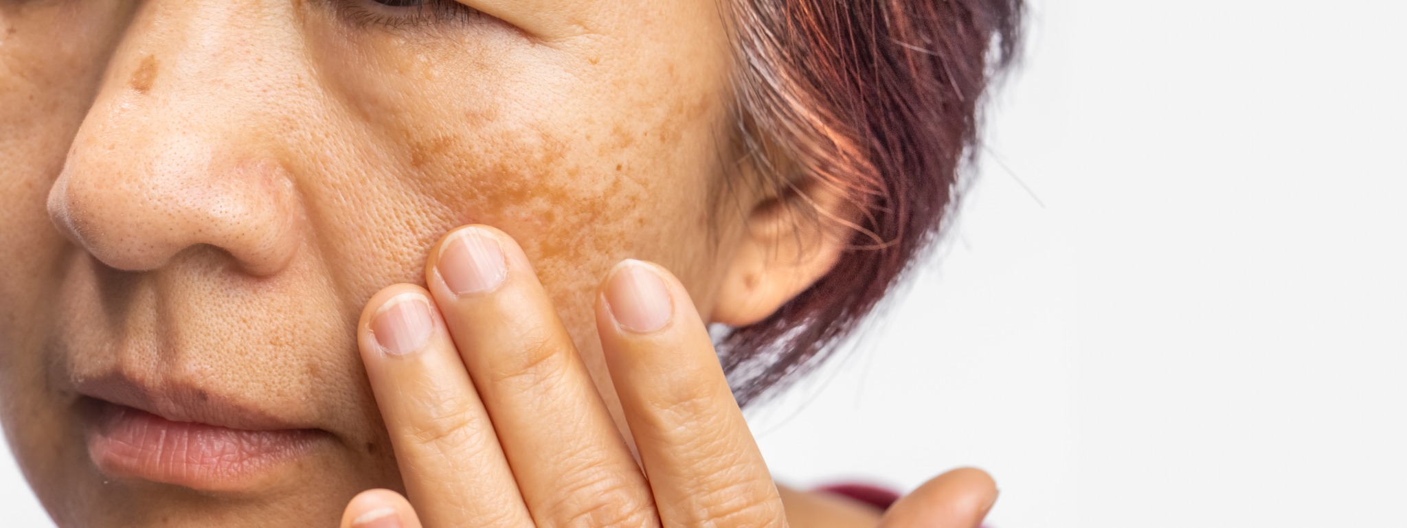 Facial pigmentation and melasma on the cheek
