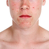 teenage_acne